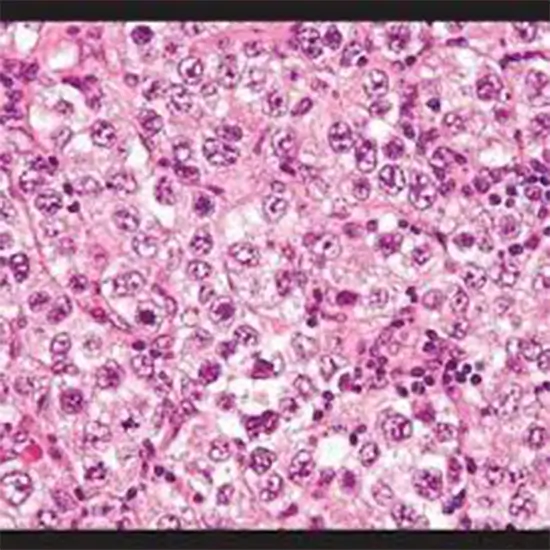 histopathology biopsy : large specimen test